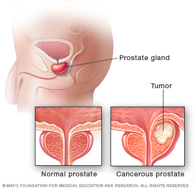 Laparoscopic Radical protatectomy